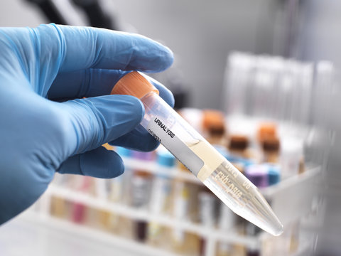 Medical technician preparing a human urine sample for clinical testing