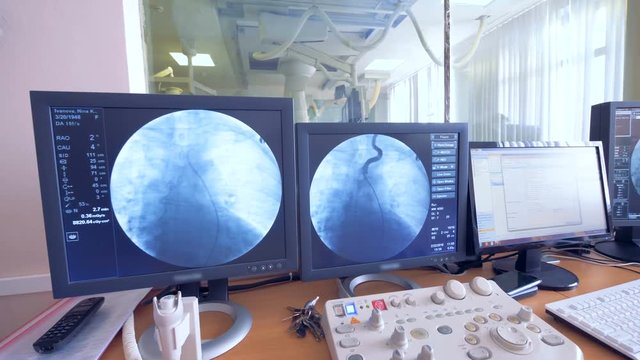 A group of surgeons are performing an operation and its process is displayed on monitors