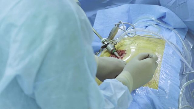 Close up hands of a surgeon making an incision with a scalpel on the abdomen of the patient