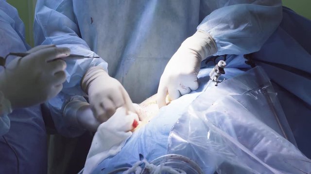 Hands of the surgeon making an incision with an electrocoagulation scalpel on the abdomen of the patient