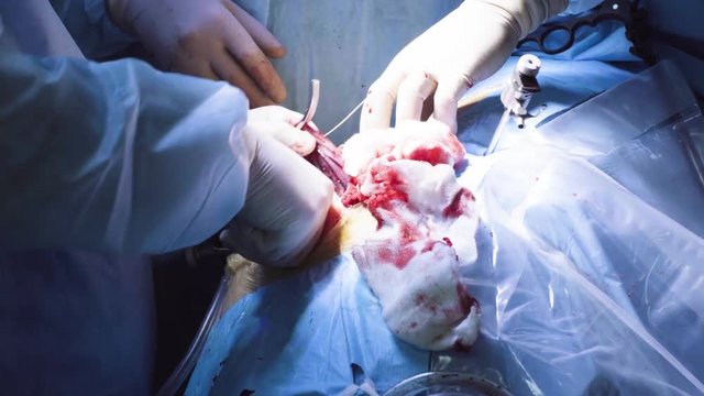Close up. Hands of the surgeon making an incision with an electrocoagulation scalpel on the abdomen of the patient