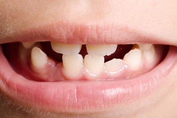 Child missing front teeth