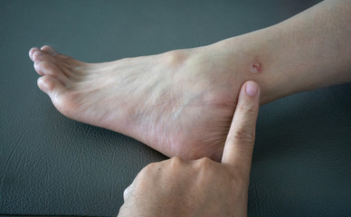 Finger pointing to the Ringworm, fungal infection of the skin