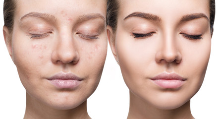 Woman with acne before and after treatment and make-up. - obrazy, fototapety, plakaty