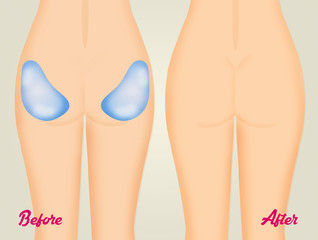 illustration of buttocks implants