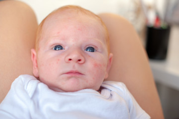 Traces of an allergy on the face of a baby