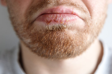 Close-up of herpes on lips cold of man. Dermatological oral skin diseases, bloating, vesicles.