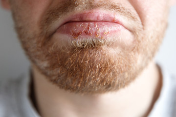 Obraz premium Close-up of herpes on lips cold of man. Dermatological oral skin diseases, bloating, vesicles.