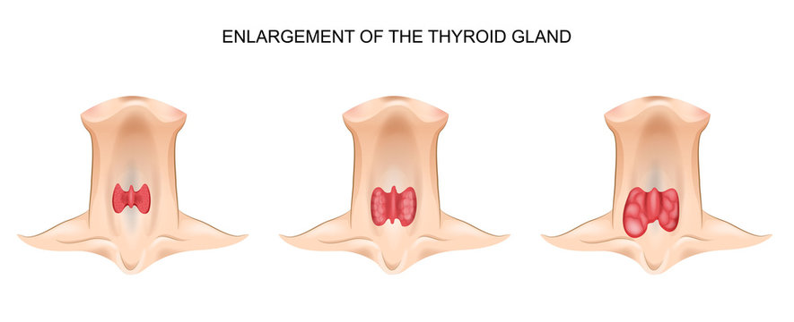 enlargement of the thyroid gland