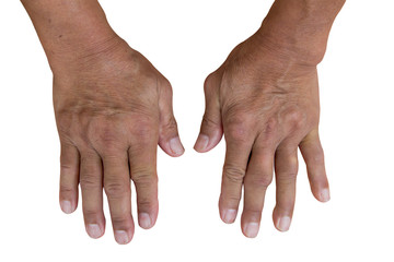 Hands disease and gout isolated or white background.