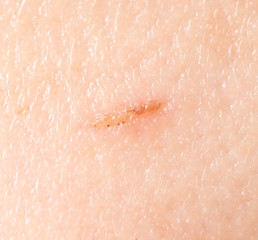 Fototapeta premium A wound on the human skin as a background