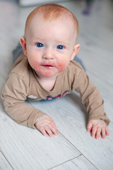 Allergies, atopic dermatitis on the face of a baby
