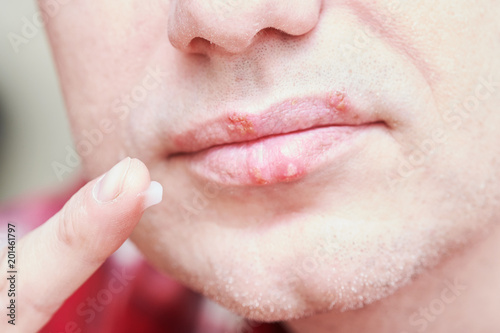 Herpes Simplex Virus Infection Lips Treatment By Cream Male Face