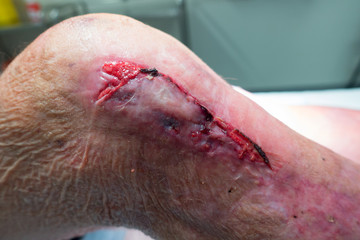 Leg wound on a senior man