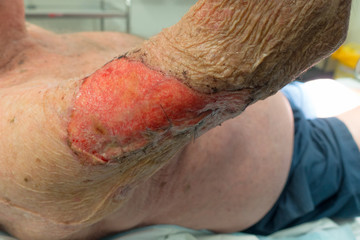 Degloved arm wound on a senior man