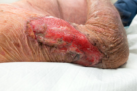 Stitches in an arm wound on a senior man