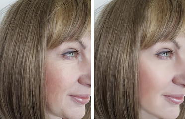 face woman wrinkles before and after procedures