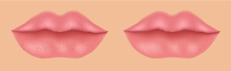 healthy and dry lip vector / mouth with no moisturizer / filler