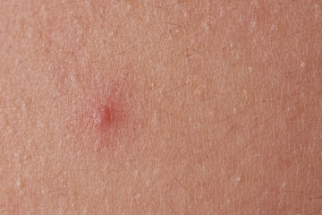 Red pimple on human skin