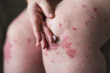 applying an emollient to dry flaky skin as in the treatment of psoriasis, eczema and other dry skin conditions. Horizontal photo