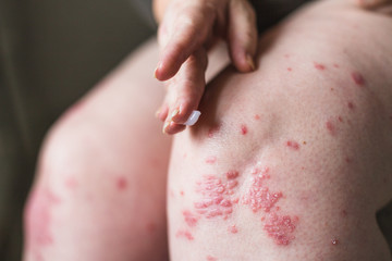 Fototapeta premium applying an emollient to dry flaky skin as in the treatment of psoriasis, eczema and other dry skin conditions. Horizontal photo