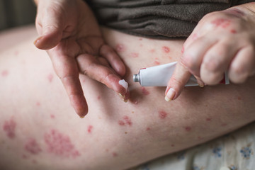 Ointment on hand. Applying the ointment in the treatment and hydration of the skin. Horizontal photo. Empty copy spase on cream tube