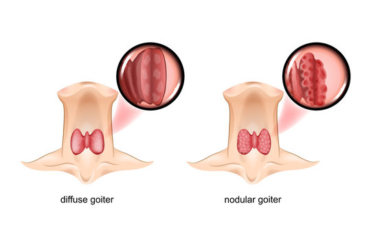 diffuse and nodular goiter, the thyroid gland is a sectional view