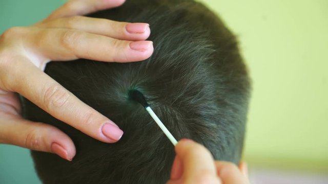 Little boy with chickenpox. Mother applying antiseptic solution to rash. Home treatment.