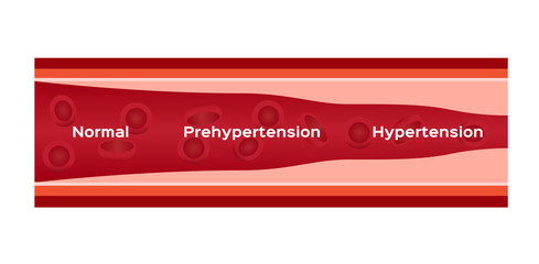 hypertension , high blood pressure vector / human anatomy