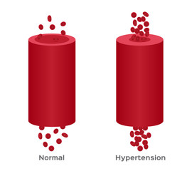 hypertension , high blood pressure vector / human anatomy