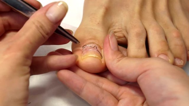 Treatment of ingrown toenails. Ingrown nail. The doctor is a podiatrist. Hardware pedicure. Podiatry.