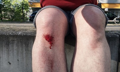 Grazed knee with blood of adult man with sports injury