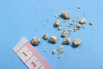very small kidney stones with ruler at blue background