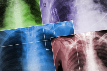 Set of the X-ray images of patients chests in the different colors, medical background