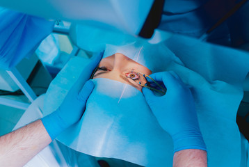 Laser vision correction. A patient and team of surgeons in the operating room during ophthalmic...