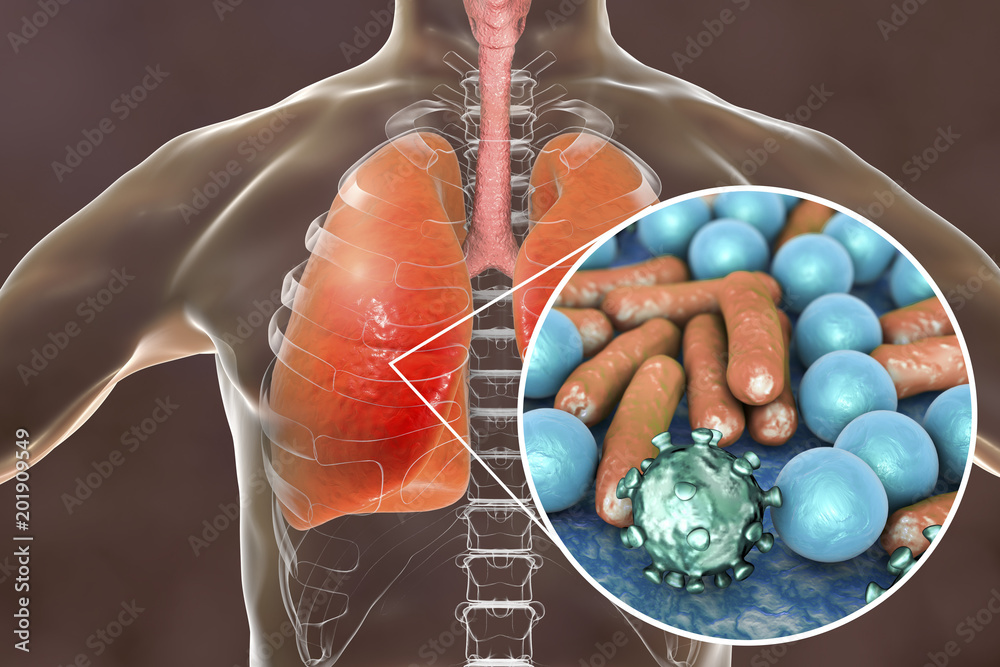 Canvas Prints Pneumonia, medical concept, 3D illustration showing human lungs and close-up view of microbes in lungs