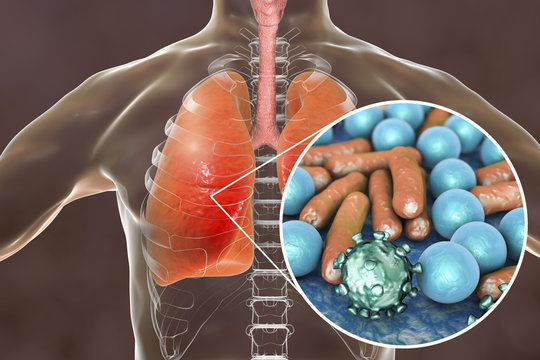 Pneumonia, medical concept, 3D illustration showing human lungs and close-up view of microbes in lungs