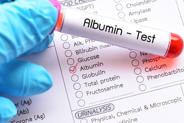 Blood sample for albumin test, diagnosis for liver function test