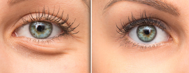 Woman eye bags before and after cosmetic treatment