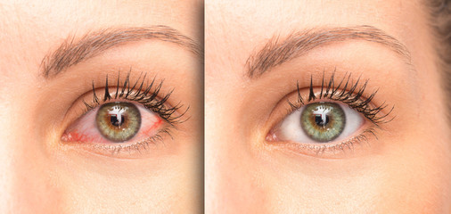 Woman eyes before and after eyewash, comparison with a red eye
