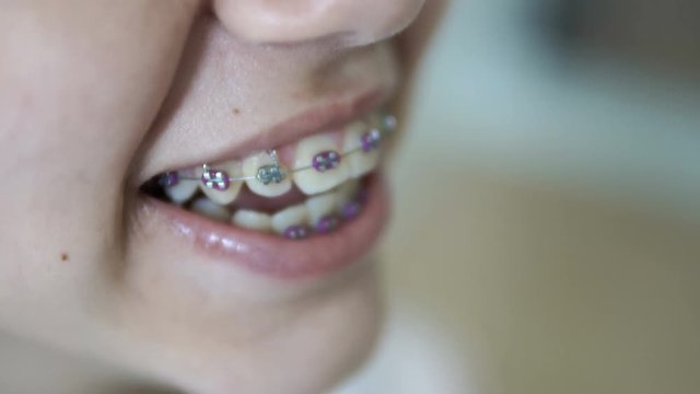 Smiling girl with orthopedic dental braces. Human Teeth