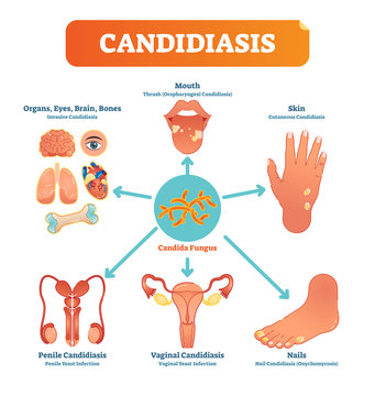 Candidiasis medical vector illustration diagram poster with all types of candida fungus on various human body parts and organs.