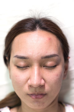 Asian beautiful woman is acne skin problem on forehead.