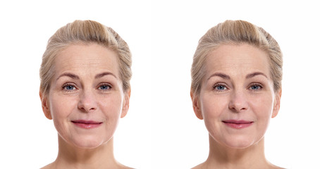 Middle aged oman face before and after cosmetic procedure. Plastic surgery concept.