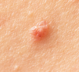 Fototapeta premium birthmark on skin