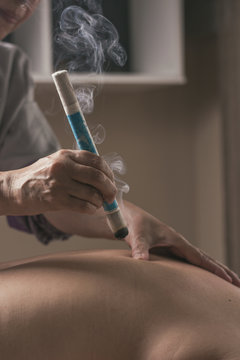 Therapist performing a moxibustion treatment.