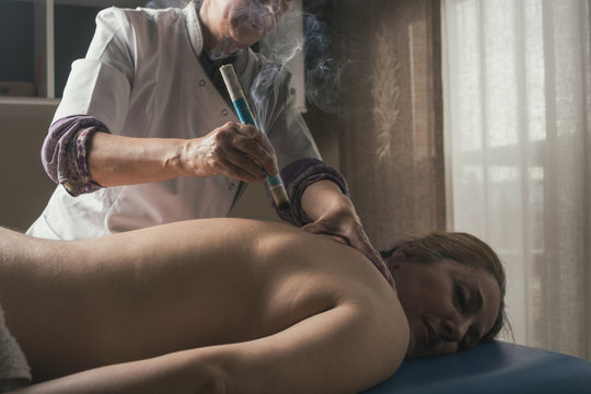 Therapist performing a moxibustion treatment.