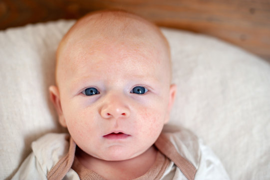 Allergies, atopic dermatitis on the face of a baby