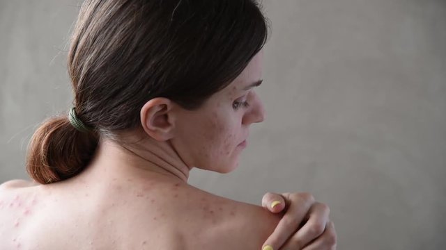 Beautiful young girl with pimples and acne on her back and face