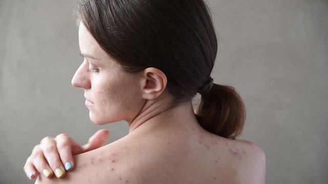 Beautiful young girl with pimples and acne on her back and face
